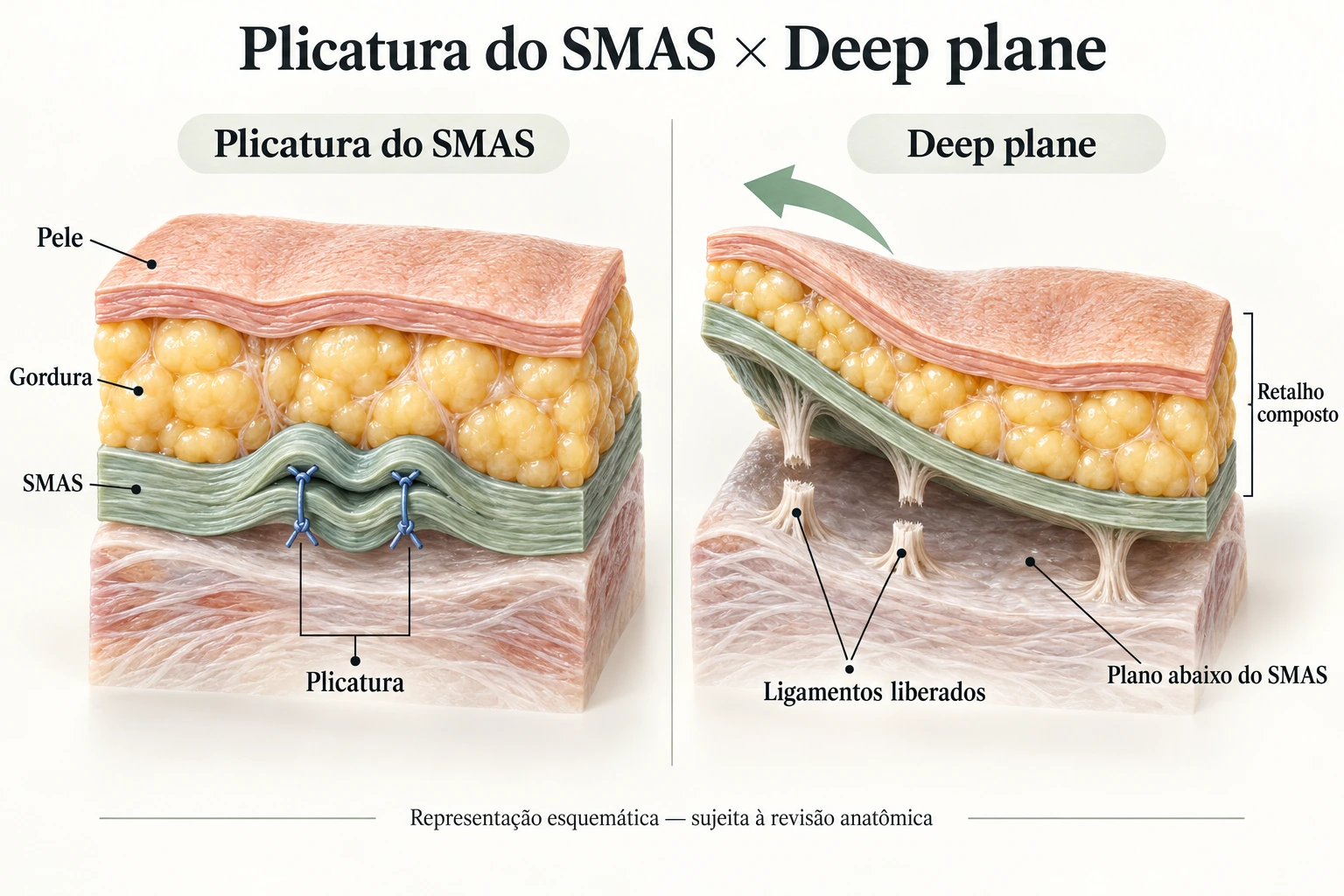 Plicatura do SMAS × Deep plane Comparação esquemática entre plicatura do SMAS com suturas e deep plane com mobilização abaixo do SMAS e liberação de ligamentos.