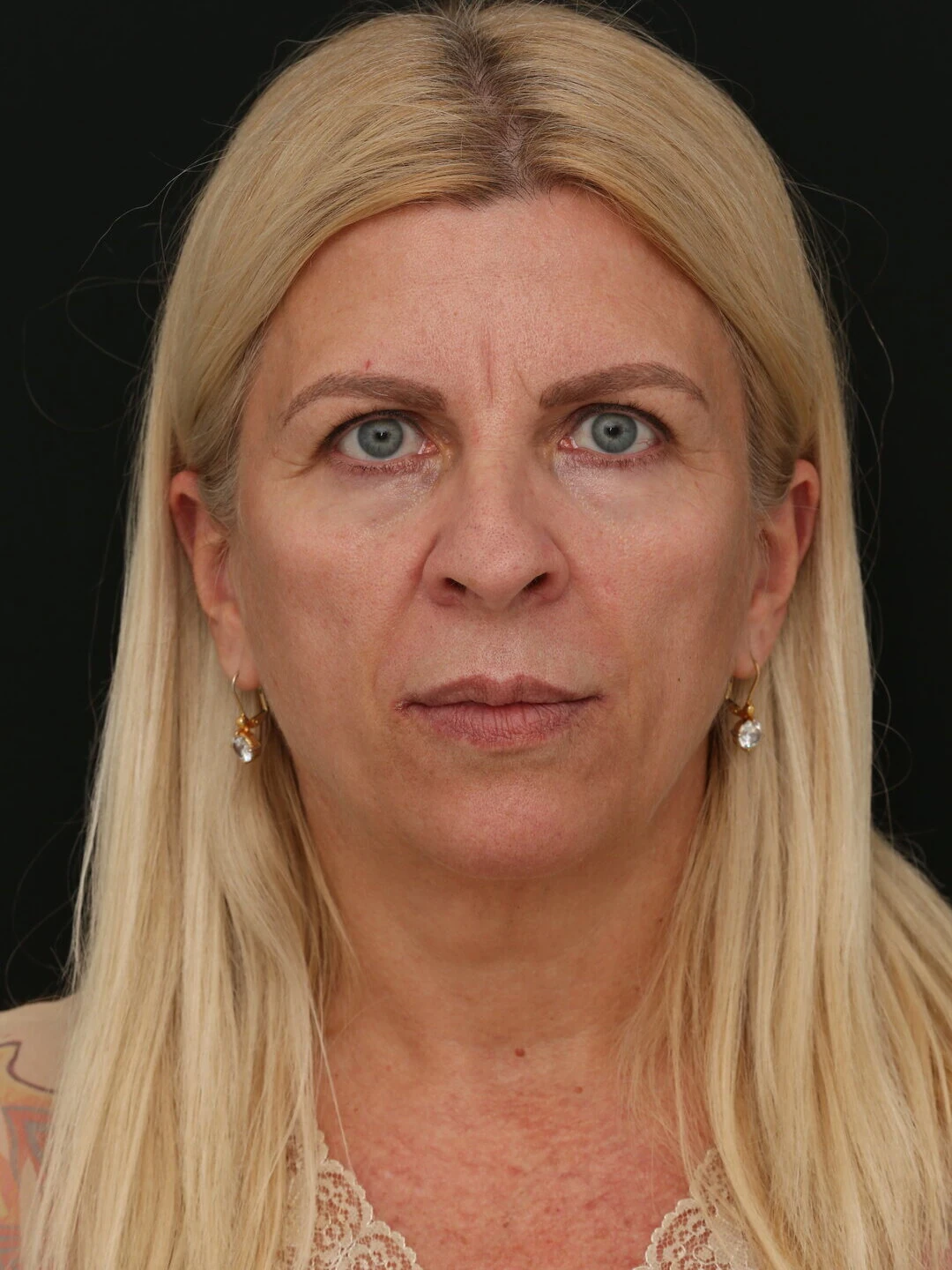 Antes, caso 2, vista frontal