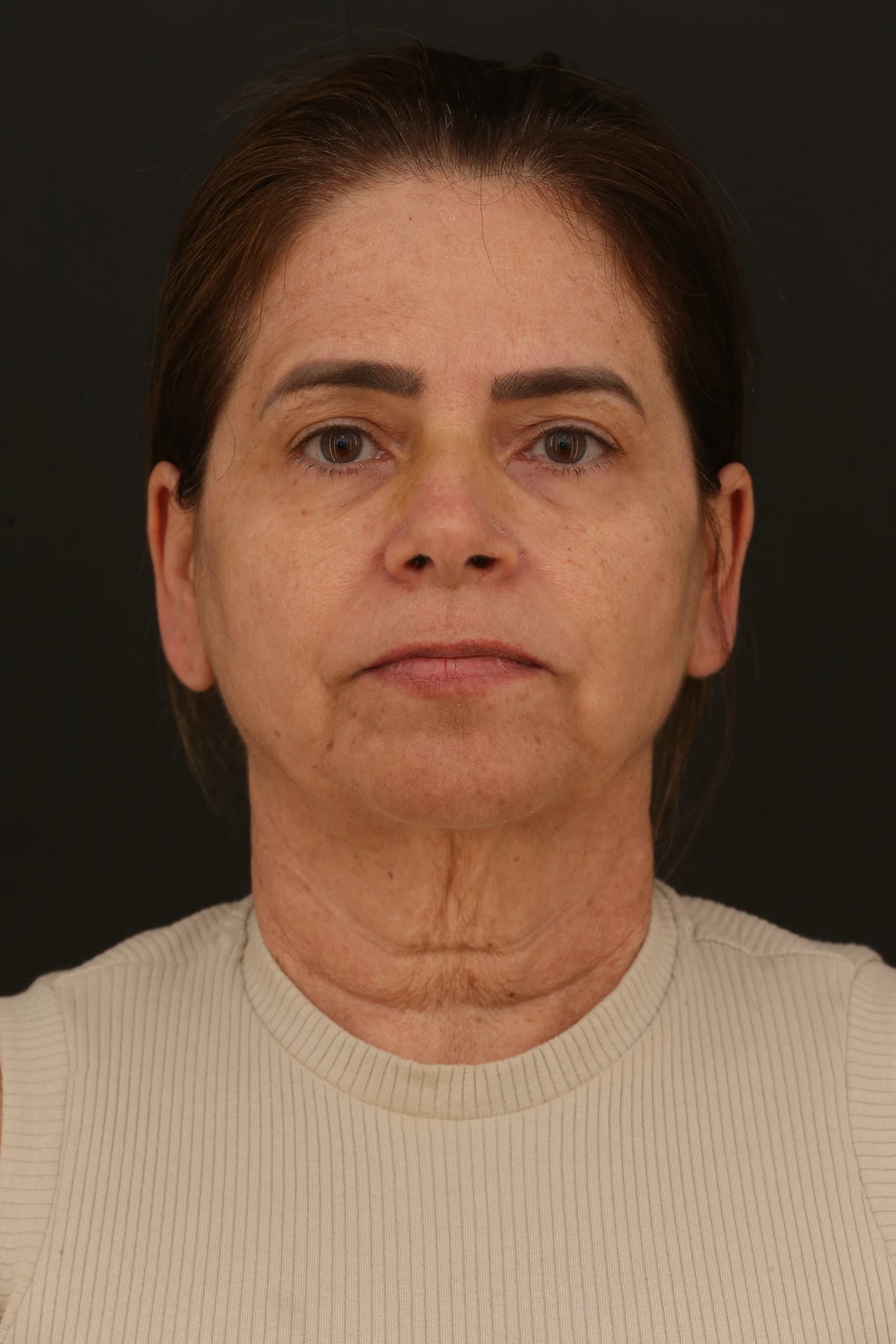Antes, caso 4, vista frontal